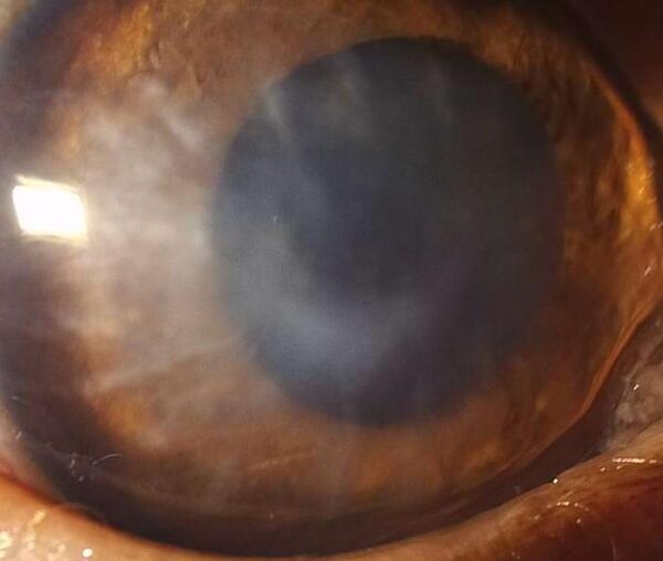 Wenn die Cornea schmilzt,  öffnen sich neue Wege