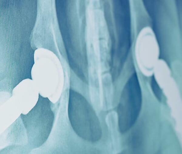 Update zur Hüftendoprothese der Firma KYON