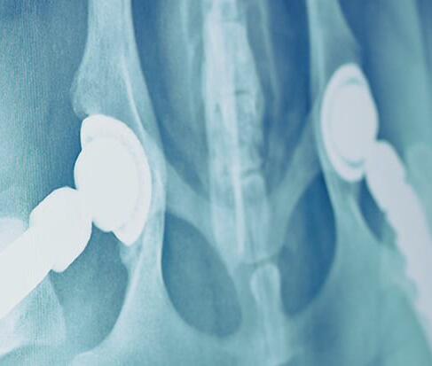 Update zur Hüftendoprothese der Firma KYON