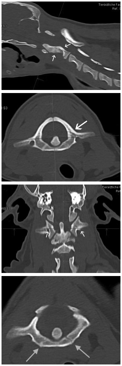 Abb 4. CT 4 Wochen post Trauma: frühe Kallusbildung mit unregelmäßiger Mineralisation im Bereich der ursprünglichen Frakturlinie