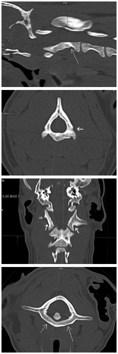 Abb 5. CT 4 Wochen post Trauma: Kallusbildung mit regelhafter Mineralisation im Bereich der ursprünglichen Frakturlinien