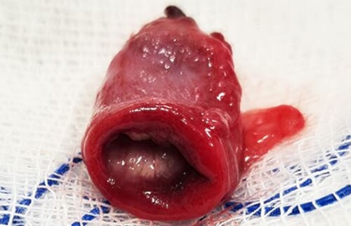 Nekrotisierter Harnblasenanteil