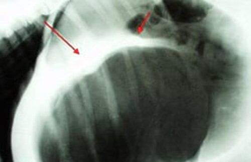 Magendrehung, R&ouml;ntgenbild vom Bauch, Faltenbildung ist durch Pfeile gekennzeichnet.