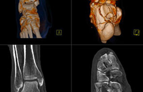 Ansichten einer Computertomographie (CT) eines Fu&szlig;es und Sprunggelenks.