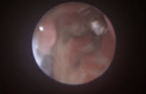 Pilzplaque in der Stirnh&ouml;hle mit ausgepr&auml;gter Nasenmuschelzerst&ouml;rung