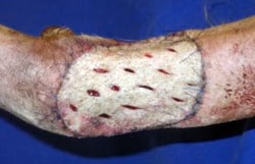 Das Hauttransplantat nach 5 Tagen.