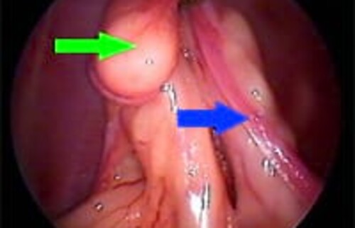 Endoskopisches Bild in die Bauchh&ouml;hle. Der Eierstock ist mit einer kleinen Zange gegriffen und angehoben. Gr&uuml;ner Pfeil: Eierstock und blauer Pfeil: Geb&auml;rmutter