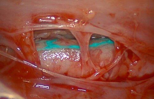 Darstellung des Ductus thoracicus mittel NIR