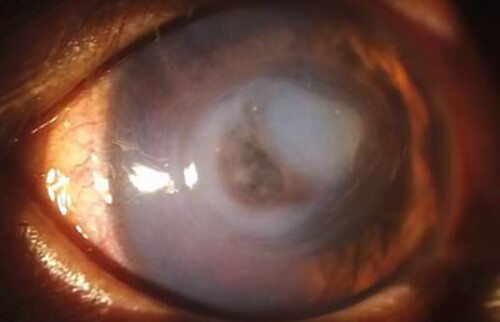 Melting cornea mit Descemetocele - die Infektion hat sich gebessert, die Defektumgebung ist fester und der Defektrand ist abgeflacht