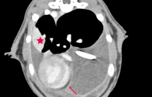 Perikarderguss (Pfeil), strukturelle Lungenver&auml;nderung (Stern)
