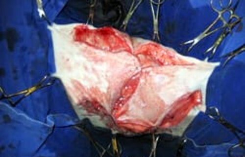 Der gro&szlig;e Defekt wird spannungsfrei mit Haut gedeckt.