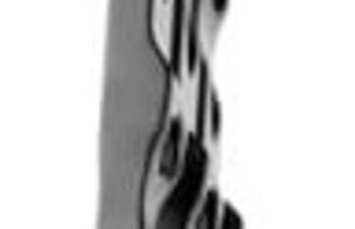 Darstellung einer Proximal Abducting Ulnar Osteotomy.