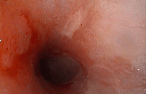 Entz&uuml;ndliche Ver&auml;nderung der Schleimhaut mit sichtbaren Reizungen und Bel&auml;gen (z. B. &Ouml;sophagitis).