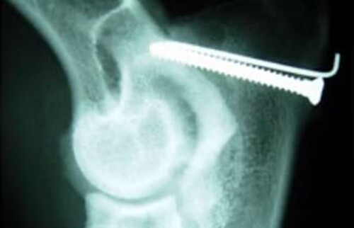 Berner Sennenhund, 6 Monate: Zugschraubenfixation mit Kortikalisschraube und Kirschner Bohrdraht.