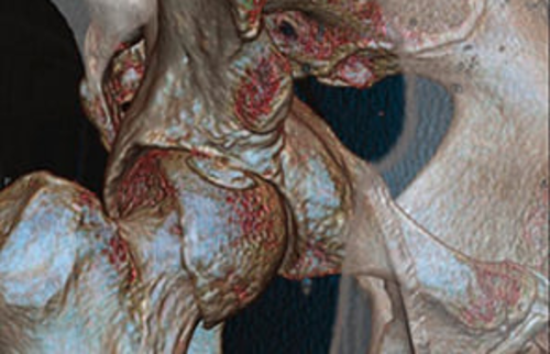 Eine 3D-Rekonstruktion einer Computertomographie (CT) eines H&uuml;ftgelenks.