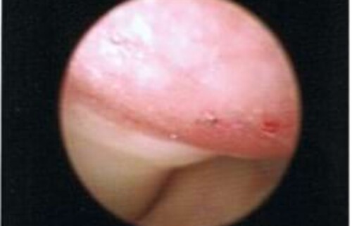Arthroskopische Aufnahme.