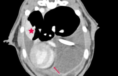 Verdickte Pleura (Pfeile)