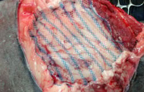 Ein Kunstnetz bedeckt die fehlende Brust- und Bauchwand.