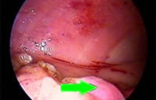 Blick an die selbe Stelle nach Entfernung der Geb&auml;rmutterhornspitze und des Eierstocks. Die Luft in der Bauchh&ouml;hle sowie die Vergr&ouml;&szlig;erung durch die Kamera erlauben eine exzellente Kontrolle von kleinen Nachblutungen. Gr&uuml;ner Pfeil: Rest des Geb&auml;rmutterhorns.