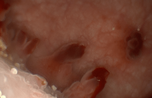 Endoskopischer Befund von tiefen Schleimhautdefekten (Geschw&uuml;ren/Ulzera) und entz&uuml;ndlichen Auflagerungen.