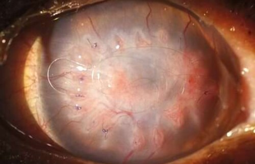 Kontrolle 3 Wochen post OP - aufgrund der Neovaskularisation ist die Hornhaut noch eingetr&uuml;bt