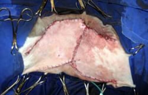 Die Wunde wurde mit zwei gegenl&auml;ufigen Rotationsflaps spannungsfrei gedeckt.