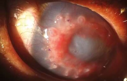 Kontrolle 12 Tage post OP - das Vetrix&reg; BioSIS Multilayer dient als Ger&uuml;st f&uuml;r die z&uuml;gige Reepithelisierung