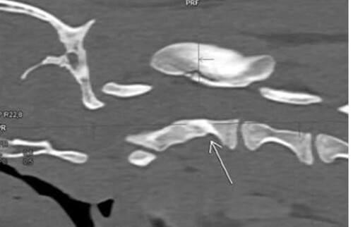 Abb. 5: CT 8 Wochen post Trauma: Kallusbildung mit regelhafter Mineralisation im Bereich der urspr&uuml;nglichen Frakturlinien