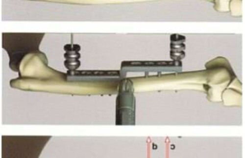 Auf der Innenseite des Oberarms wird eine Platte angebracht, die einen zentralen Knick hat. Nach Fixation der Platte wird der Oberarmknochen durchtrennt und der Knochen endg&uuml;ltig an der Platte fixiert. &Uuml;ber ca. 8-12 Wochen verheilt der Knochen &uuml;blicherweise wieder.