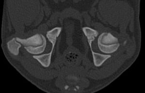 Schwarz-wei&szlig;es CT-Querschnittbild der H&uuml;ftgelenke eines Tieres.