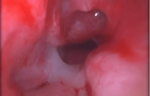 Blick in den Nasenrachenraum: Untersuchung auf Entz&uuml;ndungen oder Ver&auml;nderungen im Bereich der oberen Atemwege.