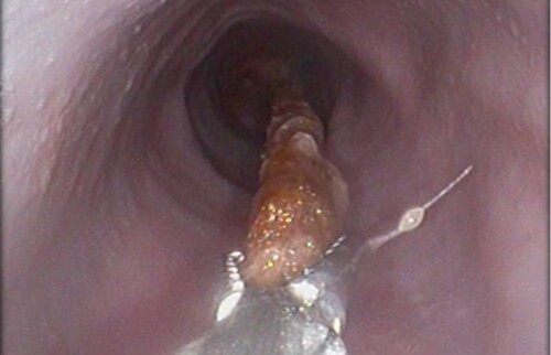 Endoskopische Entfernung eines Fremdk&ouml;rpers (z. B. Kauknochen) aus der Speiser&ouml;hre mittels Fasszange.