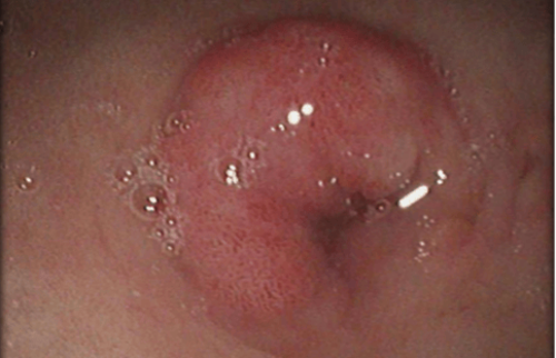 Endoskopische Ansicht einer knotigen Schleimhautver&auml;nderung (z. B. Polyp oder kleiner Tumor).