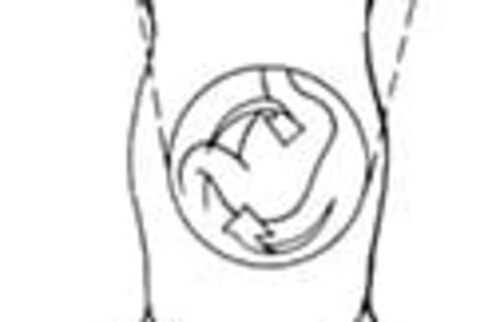 Verlagerung des Magenausgangs auf die linke Seite.