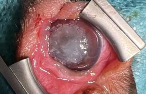Nach Entfernung der lytischen Hornhautanteile wird ein Vetrix&reg; BioSIS mit resorbierbarem 9-0 Vicryl adaptiert