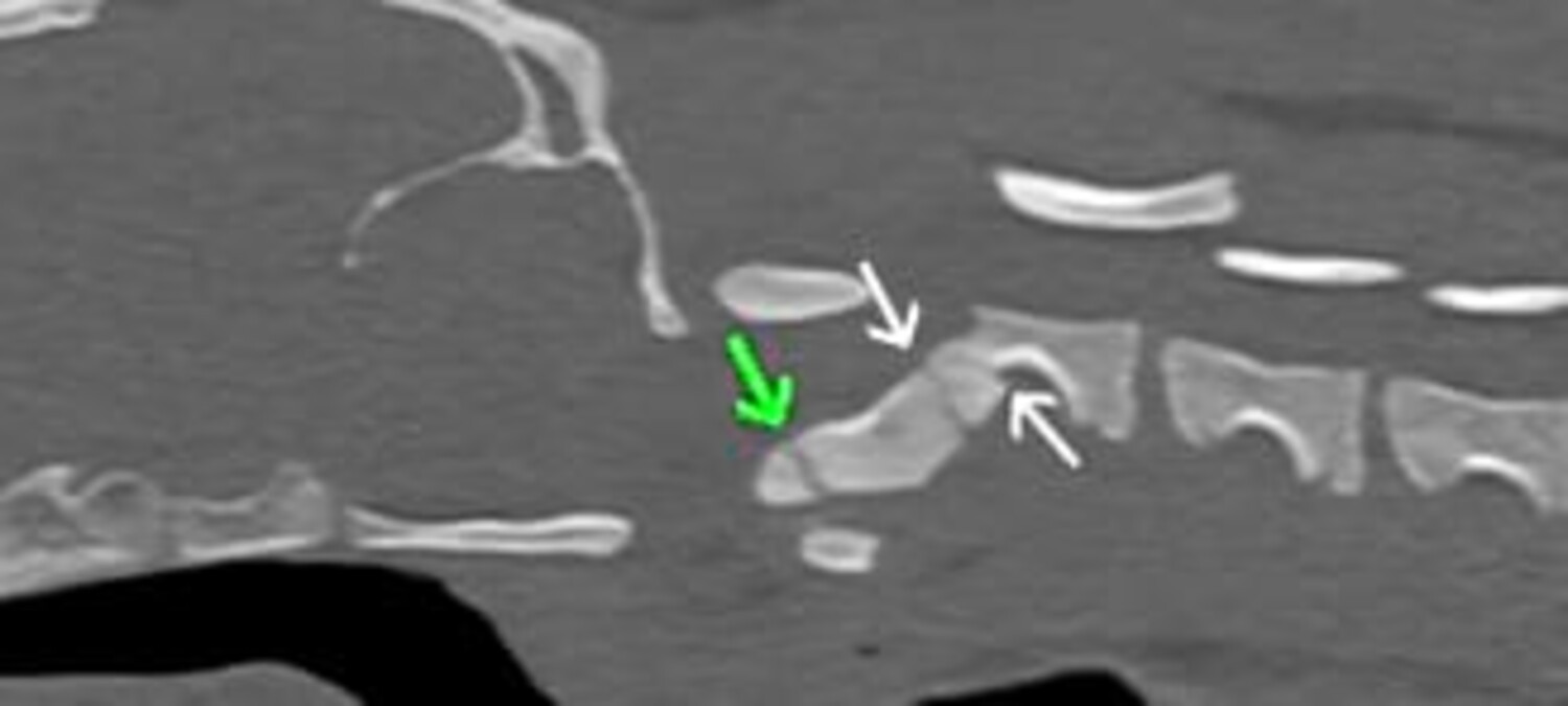 R&ouml;ntgenaufnahme einer Halswirbelfraktur.