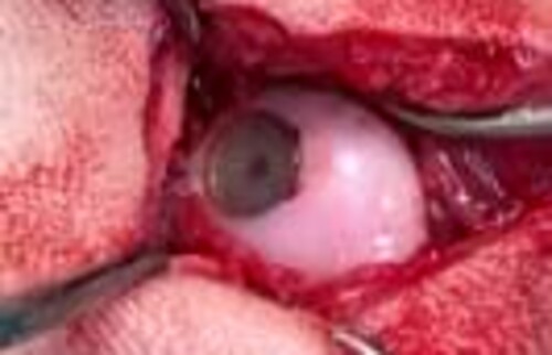 Blick in das Schultergelenk mit implantierter Synachartendoprothese