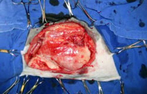 Abtragung des Gewebes um den Tumor .